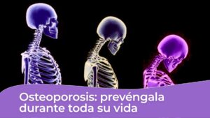 Osteoporosis - prevencion durante la vida