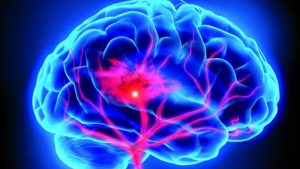 ¿Qué es un aneurisma cerebral?