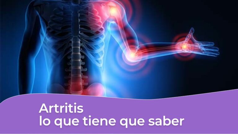 Artritis - lo que tiene que saber