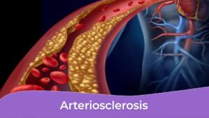 arteriosclerosis en personas y adultos mayores