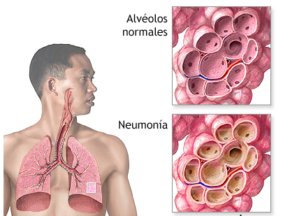neumonia - inflamación aguda producida por una infección de los alveolares