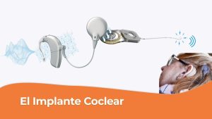 Implante coclear